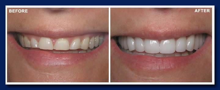 Home instant teeth whitening